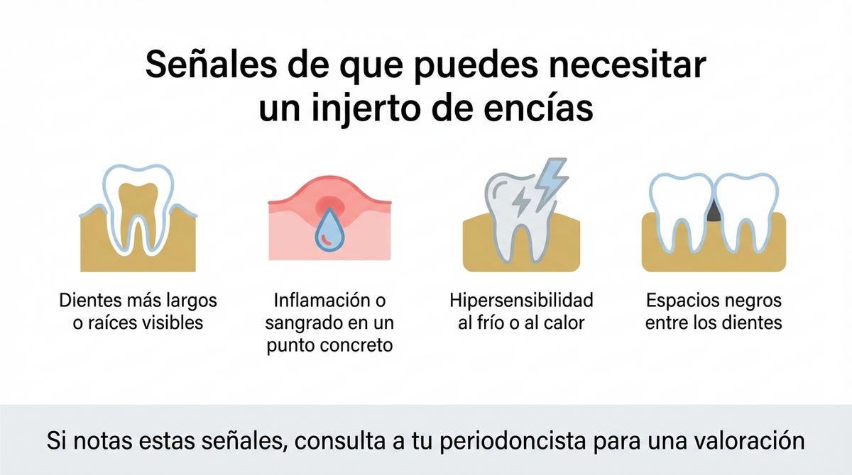 Infografía con cuatro señales visuales que ayudan a identificar cuándo puede ser necesario un injerto de encías.