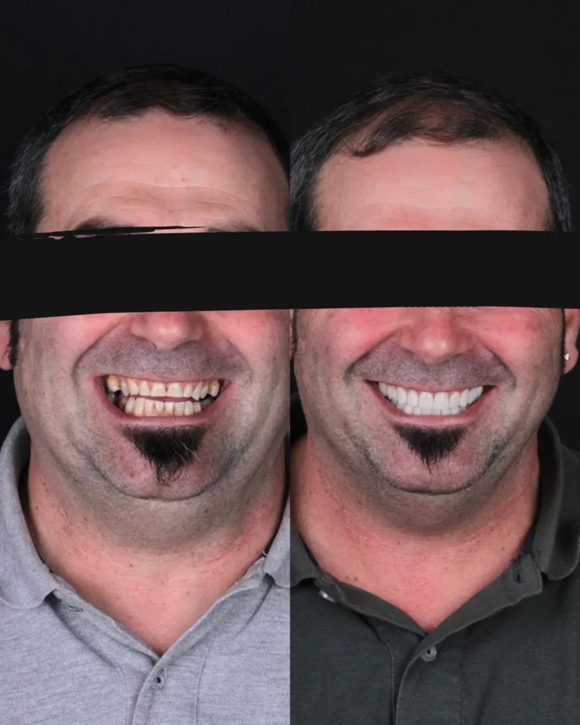 Antes Y Despues Carillas