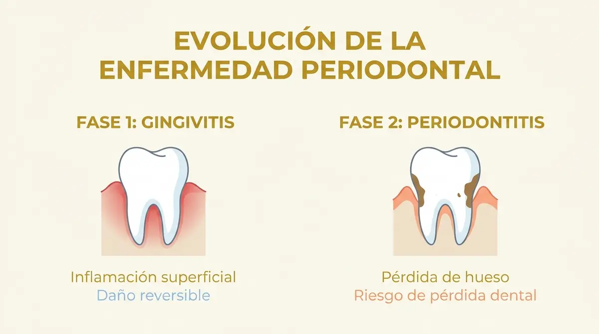 Infografía comparativa que muestra las fases de gingivitis y periodontitis en la salud bucodental.
