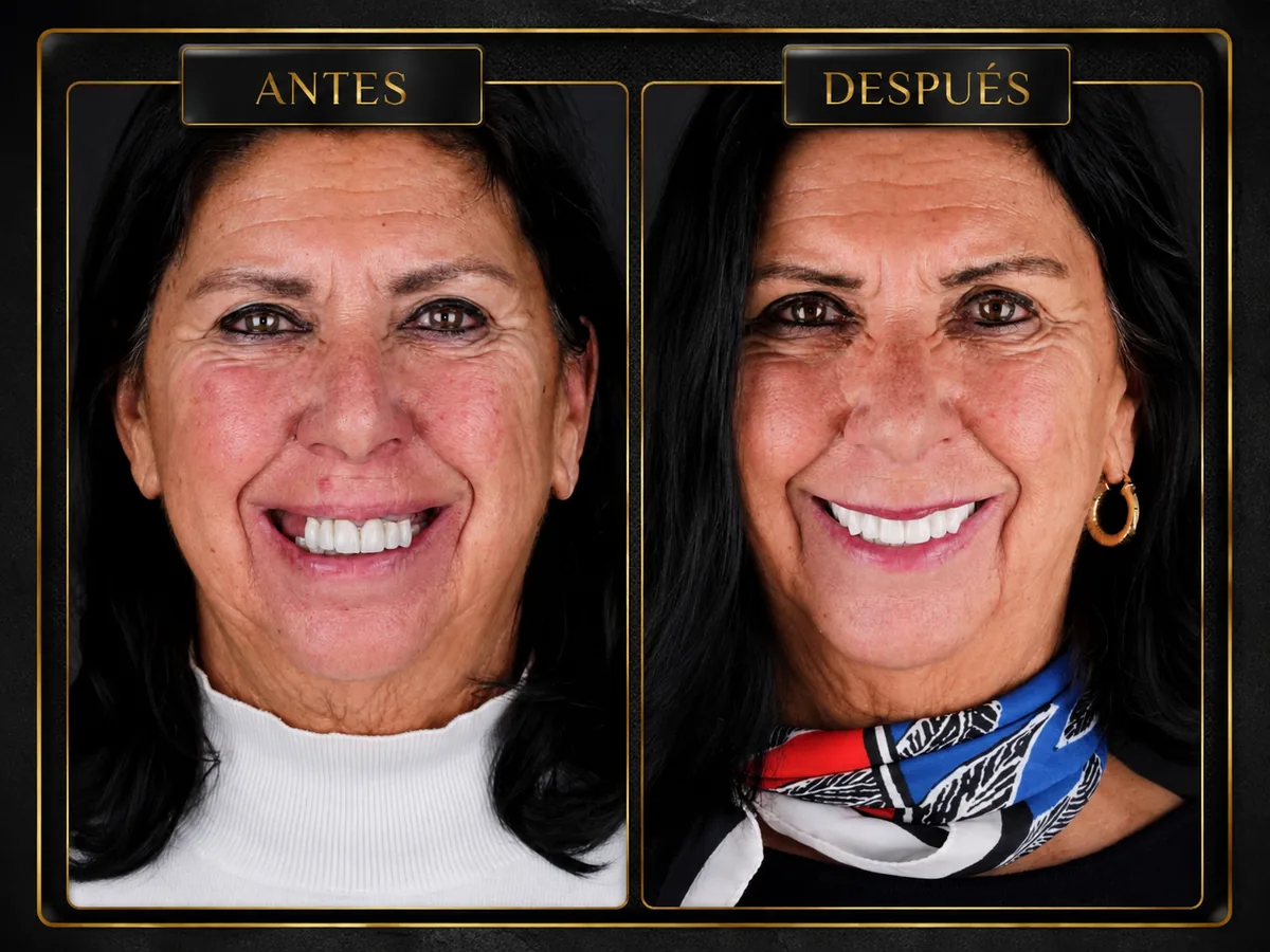 Antes y después de un caso real tratado en Atelier Dental